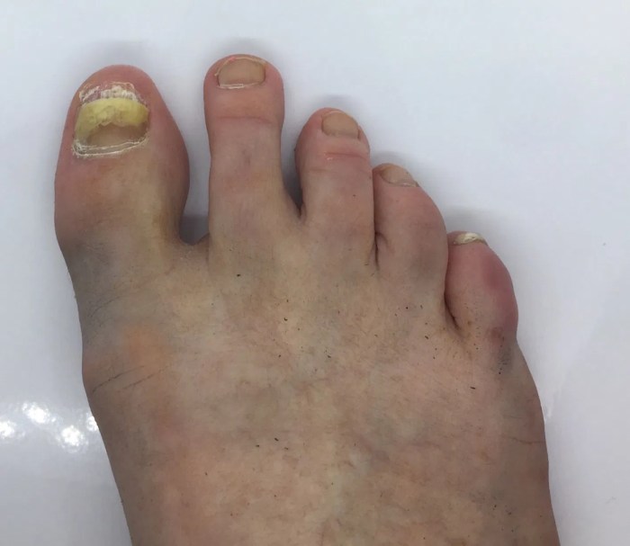 False toe nails for fungal nail infection